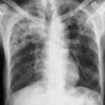 Dia mundial da tuberculose: novos antibióticos dão esperança no combate à doença