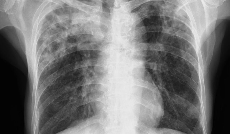 Dia mundial da tuberculose: novos antibióticos dão esperança no combate à doença