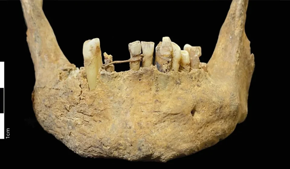ponte dentária antiga feita com fio de ouro