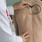 Tratamento promissor para o câncer de pele está em testes no Brasil