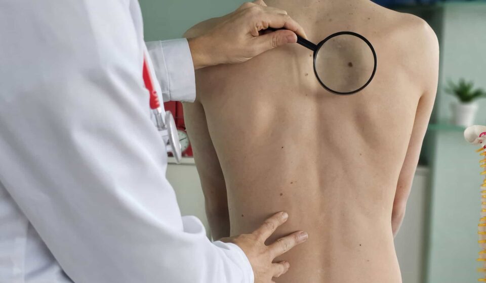 Tratamento promissor para o câncer de pele está em testes no Brasil