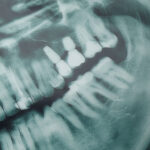 USP desenvolve IA que ajuda dentistas a detectar cáries em radiografias