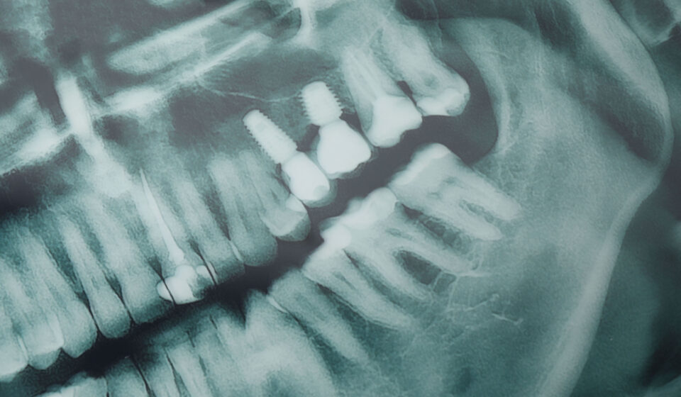USP desenvolve IA que ajuda dentistas a detectar cáries em radiografias